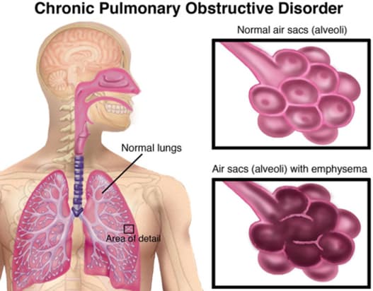 COPD