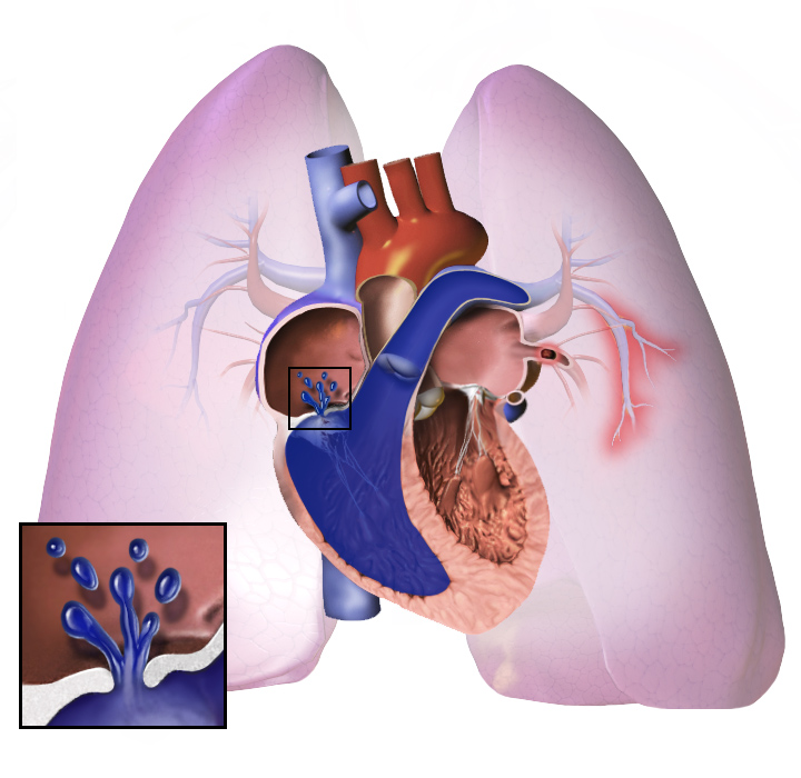 Pulmonary HyperTension